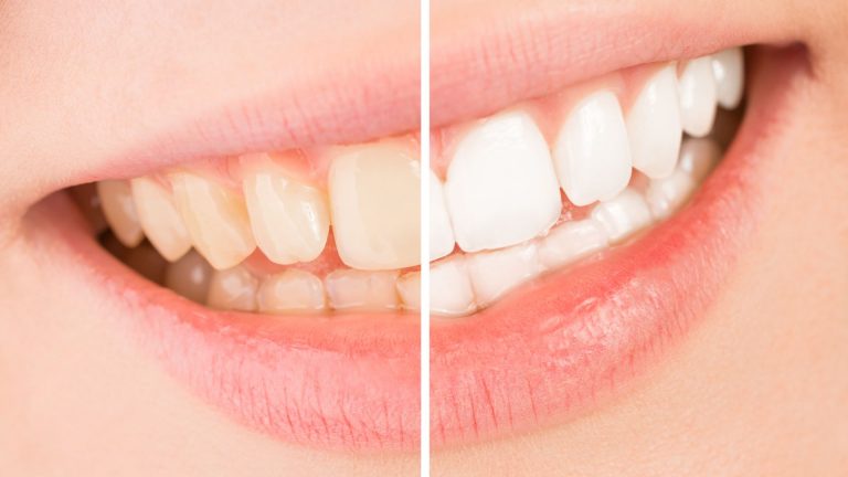 Read more about the article 7 mitos e verdades do clareamento dental