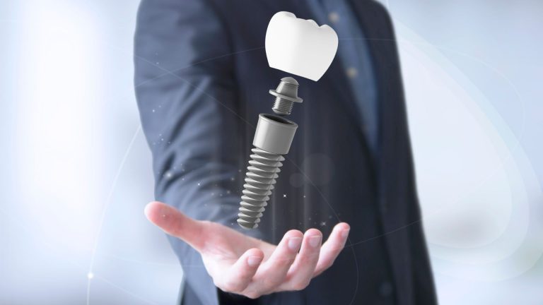Read more about the article 10 dúvidas comuns sobre implantes dentários