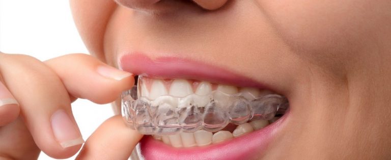 Read more about the article Invisalign: 5 motivos para trocar os braquetes pelos alinhadores